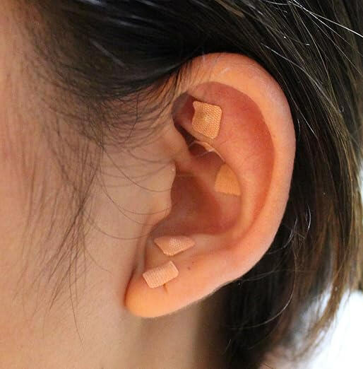 Ear Seeding Accupressure